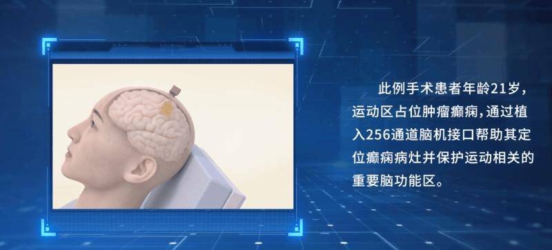 上海：2027年前实现高质量脑控 半侵入式脑机接口产品在国内率先实现临床应用